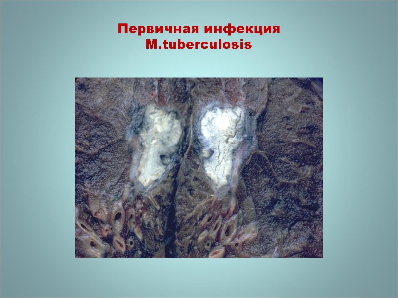 Первичная инфекция M.tuberculosis